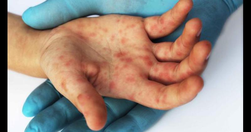 El sarampión vuelve a preocupar: cuáles son los síntomas